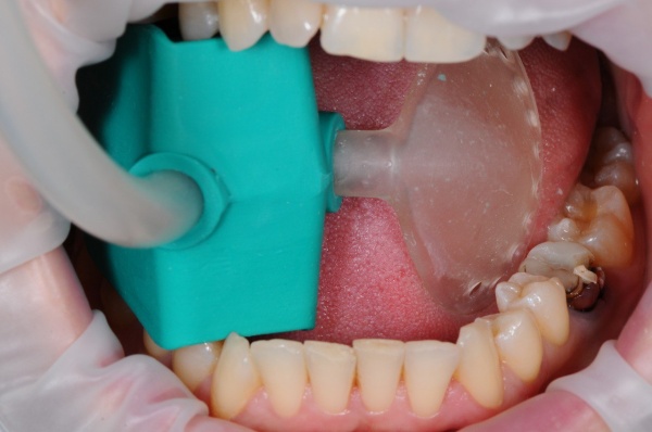 Аспирационно ретракционная система Freestom solid размер L Аспирационно ретракционная система Freestom solid размер L